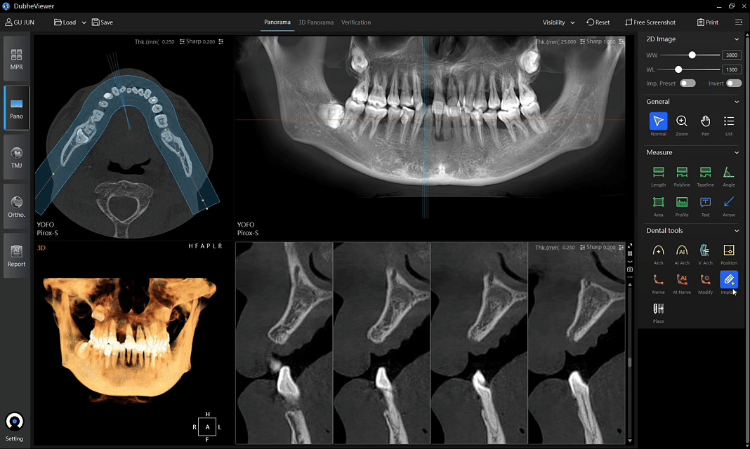 Select an implant from the integrated library